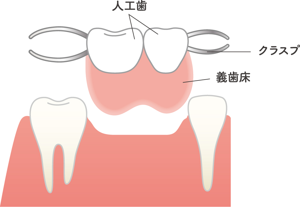 部分入れ歯構成