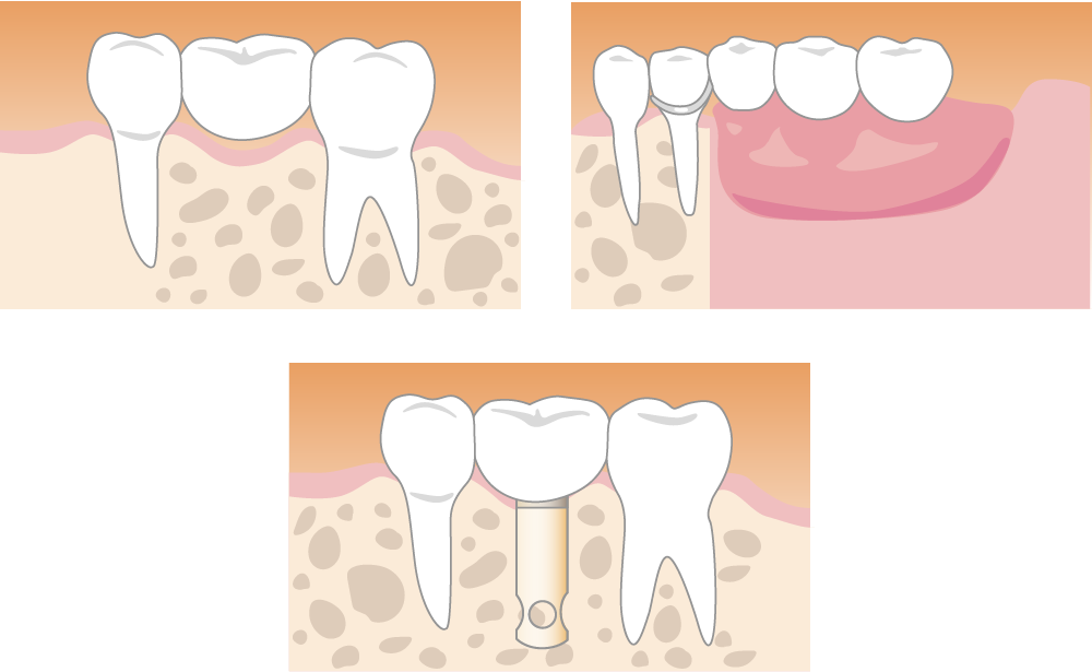 ブリッジ・入れ歯・インプラントの3種類